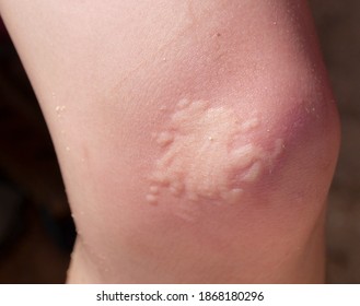 Painful Allergic Reaction Wasp Sting Stock Photo (Edit Now) 483768985