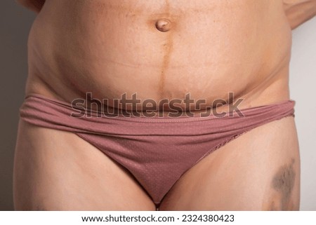 The seam on the abdomen of a woman after a caesarean section. Recovery of the female body after the birth of a child, complications.