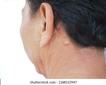 Sebaceous Cyst On The Neck Man Form Out Of Sebaceous Gland The Oil Called Sebum And Skin Treatment Of Laser Or Punch Biopsy Excision.