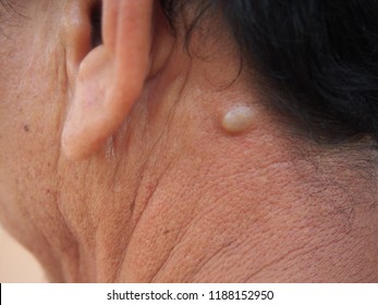 Sebaceous Cyst On The Neck Man Form Out Of Sebaceous Gland The Oil Called Sebum And Skin Treatment Of Laser Or Punch Biopsy Excision.