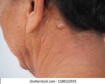 Sebaceous Cyst On The Neck Man Form Out Of Sebaceous Gland The Oil Called Sebum And Skin Treatment Of Laser Or Punch Biopsy Excision.