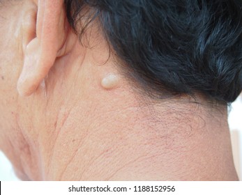 Sebaceous Cyst On The Neck Man Form Out Of Sebaceous Gland The Oil Called Sebum And Skin Treatment Of Laser Or Punch Biopsy Excision.