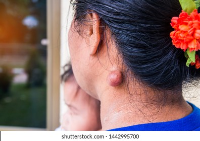 Sebaceous Cyst On The Neck Woman Form Out Of Sebaceous Gland The Oil Called Sebum And Skin Treatment Of Laser Or Punch Biopsy Excision.Medical Concepts.