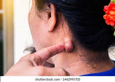 Sebaceous Cyst On The Neck Woman Form Out Of Sebaceous Gland The Oil Called Sebum And Skin Treatment Of Laser Or Punch Biopsy Excision.Medical Concepts.