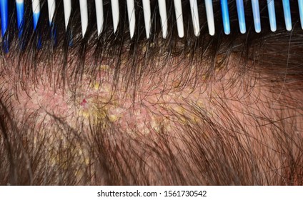 Seborrea eczema in hair skin dermatology closeup of disease symptom