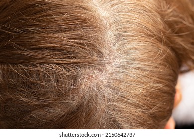 Seborrhea Dermatitis Condition On Female's Scalp. A Close-up Of An Irritated Itchy Scalp With Red Scabs. Skin Problem In A Human Head.