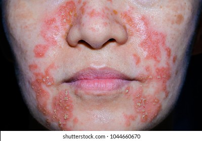 Seborrheic Dermatitis In Adult Face Isolated Black Background