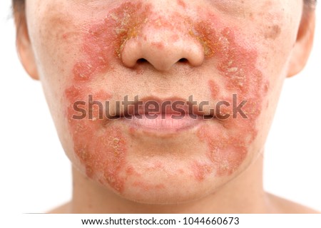 Similar – Image, Stock Photo Psoriasis skin with red wounds. Male arms with cracked, hard, horny, flaky skin. Dermatological problems of allergy, eczema. Hand stains, rash, dry skin. The concept of chronic disease treatment