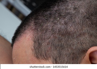 Seborrheic Dermatitis Images Stock Photos Vectors Shutterstock