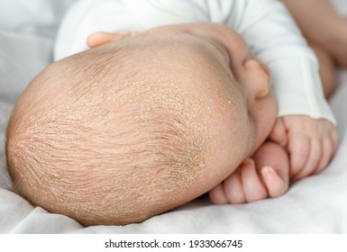 Seborrheic Dermatitis Crusts On The Baby's Head. Child With Seborrhea In The Hair, Newborn Skin Problems