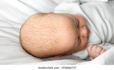 Seborrheic Dermatitis Crusts On The Baby's Head. Child With Seborrhea In The Hair, Newborn Skin Problems