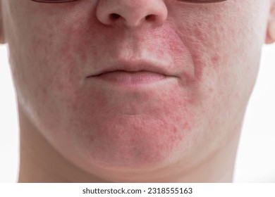 Dermatitis Seborréica En la cara de una niña de origen blanco aislado. Acné vulgaris y cicatrices sobre toda la cara de una mujer italiana.