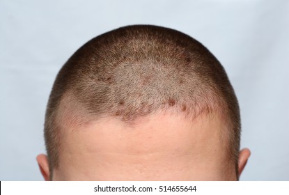 Head Scalp Images Stock Photos Vectors Shutterstock