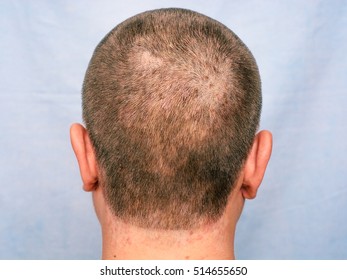 Seborrheic Dermatitis Images Stock Photos Vectors Shutterstock