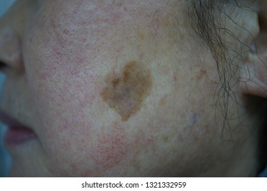 Seborrheic Keratosis Of The Cheek