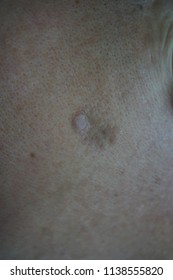 Seborrheic Keratosis Of The Face.