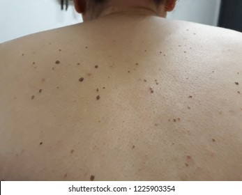 Seborrheic Keratosis Is A Non-cancerous Tumor. It Looks Like A Small Skin Like Warts Raised From The Skin. Usually Found On The Face, Chest, Shoulders And Back Does Not Cause Pain.