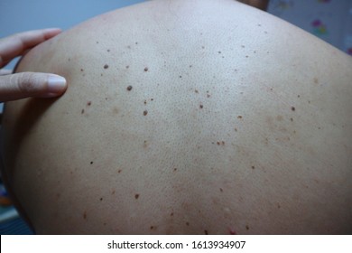 Seborrheic Keratosis Is A Non-cancerous Tumor. It Looks Like A Small Skin Like Warts Raised From The Skin. Usually Found On The Face, Chest, Shoulders And Back Does Not Cause Pain