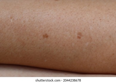 Seborrheic Keratosis Is A Non-cancerous Tumor. It Looks Like A Small Skin Like Warts Raised From The Skin. Usually Found On The Face, Chest, Shoulders And Back Does Not Cause Pain