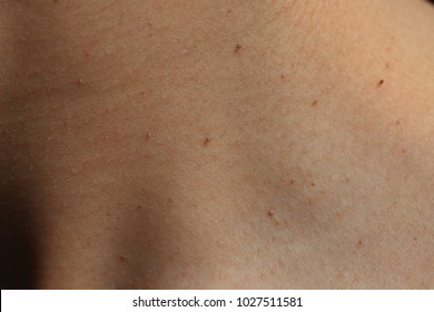 Seborrheic Keratosis On Neck