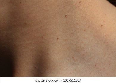 Seborrheic Keratosis On Neck