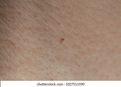 Seborrheic Keratosis On Neck