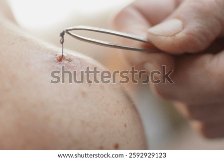 Second attempt to remove a forgotten retained suture or suture fragment from the shoulder of a Caucasian man in Lithuania