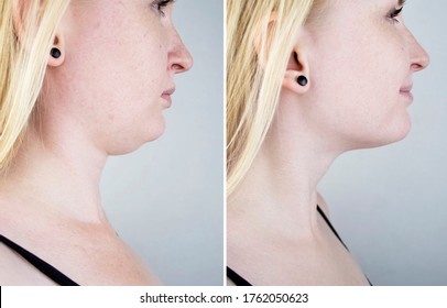 Second chin lift in women. Photos before and after plastic surgery, mentoplasty or facebuilding. Chin fat removal and face contour correction