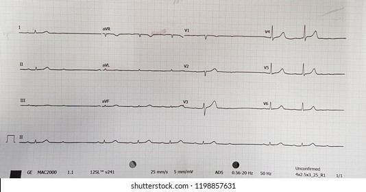 Second Degree Av Block Mobitz 1 With Sinus Bradycardia, Binodal Disease