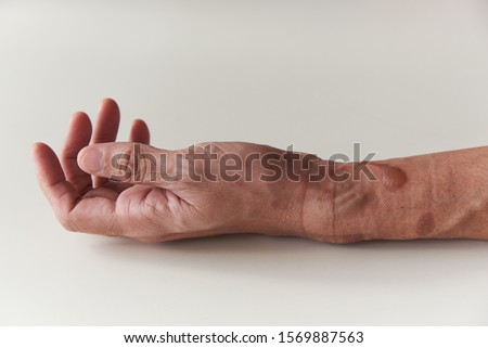 Second degree burn with blisters at woman left forearm and wrist on white background