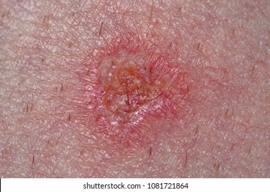 Second-degree Burn Images, Stock Photos & Vectors 