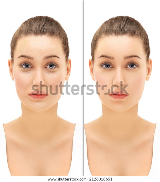The Secret of Makeup. Before-\
After,Portrait of beautiful girl  with problem and clear skin\
