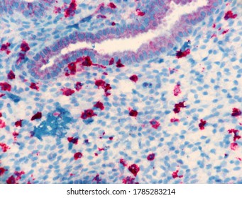 Section Of Endometrium With Numerous Natural Killer Cells Which Have Bright Red Expression Of The Marker, CD 56. Glands And Stroma Are Light Blue. Microscopic View. 