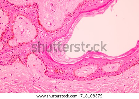 Section tissue of breast cancer view in microscopy.Glandular epithelial cells.Ductal cell carcinoma.