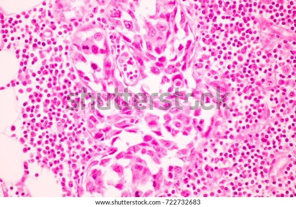 Section Tissue Breast Cancer View Microscopyglandular Stock Photo (edit 