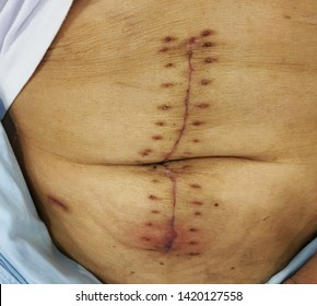 Selective Focus Of Abdominal Scars ,stitch Marks On Abdomen Skin Because Surgical Midline Incision Is Major Open Operation After Colon Cancer Colectomy Calls Hemicolectomy In Colorectal Cancer Patient