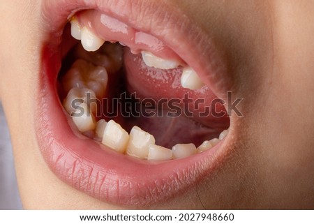 Similar – gap between one’s teeth