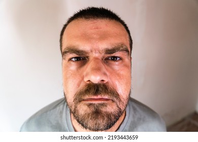 Selective Focus, Close Up, High Angle View Shot Of A Caucasian Bearded Man With Sweaty Face.