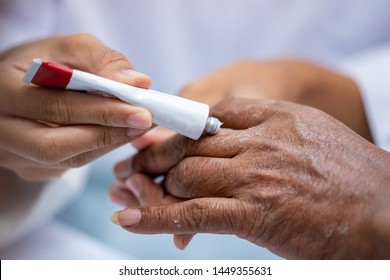 Selective Focus Close Up Woman Pharmacist Or Doctor Hand Apply Steroid Moisturizer Cream On Old Asian Man Hand With Flaking Dry Itchy Skin Conditions Peeling By Allergic Dermatitis.