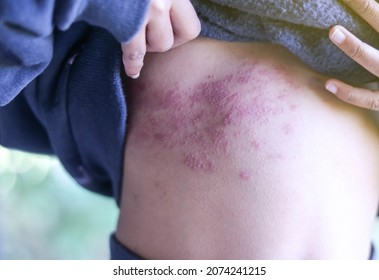 Selective focus of detail on body kid skin with Shingles (Disease), Herpes zoster, varicella-zoster virus. skin rash and blisters.