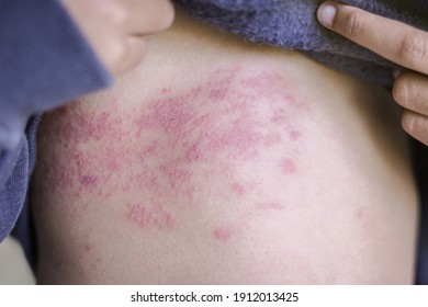 Selective focus of detail on kid skin with Shingles (Disease), Herpes zoster, varicella-zoster virus. skin rash and blisters. 