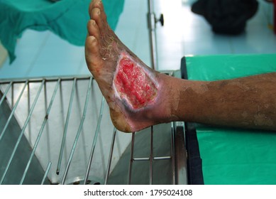 Selective Focus Diabetic  Foot Ulcer.