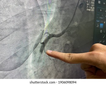 Selective focus finger point lesion of right coronary artery on x-ray monitor
