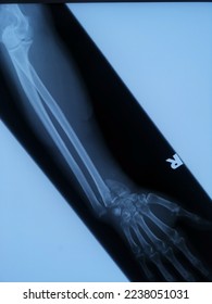 Selective Focus of A Hand X-ray with Fracture and Dislocation over Left Radius and Ulna Bone due to Fall. This Case was Referred to Orthopedic Specialist for further management  - Shutterstock ID 2238051031