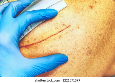 156 Pacemaker Scar Images, Stock Photos & Vectors | Shutterstock