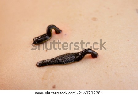 Selective focus on one of the leeches. the leech sucks blood from the back of the neck. bloodletting procedure