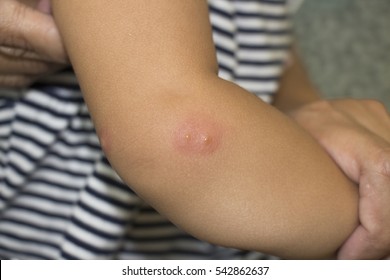 Selective focus skin rash and 2 small vesicular lesions the rash showing like bull eyes kidney shape found the lateral side right elbow no pain but itchy