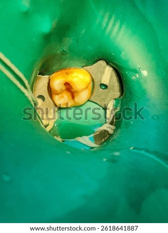 selective focus picture of class 1 cavity preparation for caries excavation for composite restoration on the molar with rubber dam isolation