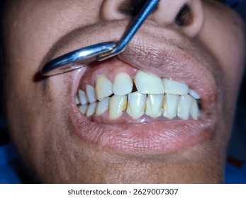 selective focus picture of generalized accumulation of dental plaque and calculus due to poor oral hygiene