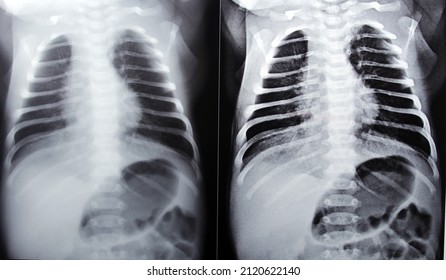 Selective focus of a plain chest x ray for a newborn infant in incubator with a right lung congenital pneumonia at the right apex where small opaque patches could be seen indicating the inflammation